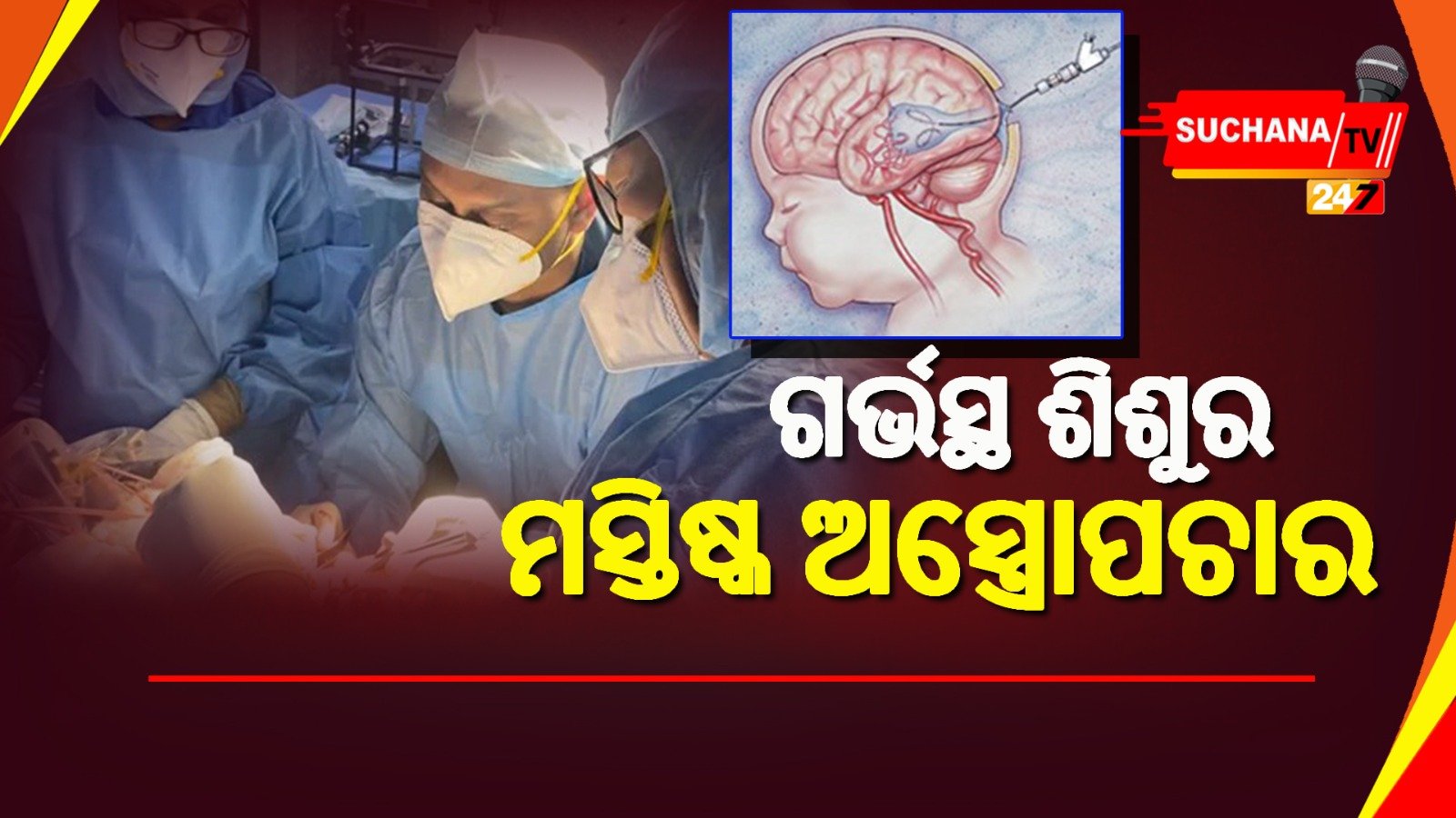 ୩୪ ସପ୍ତାହର ଗର୍ଭସ୍ଥ ଶିଶୁ ମସ୍ତିଷ୍କର ଅସ୍ତ୍ରୋପଚାର